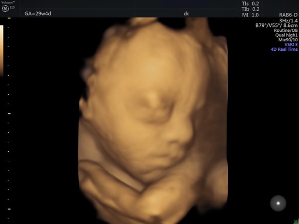 Trimester Scan | 28 Weeks Pregnancy Scan | Perth