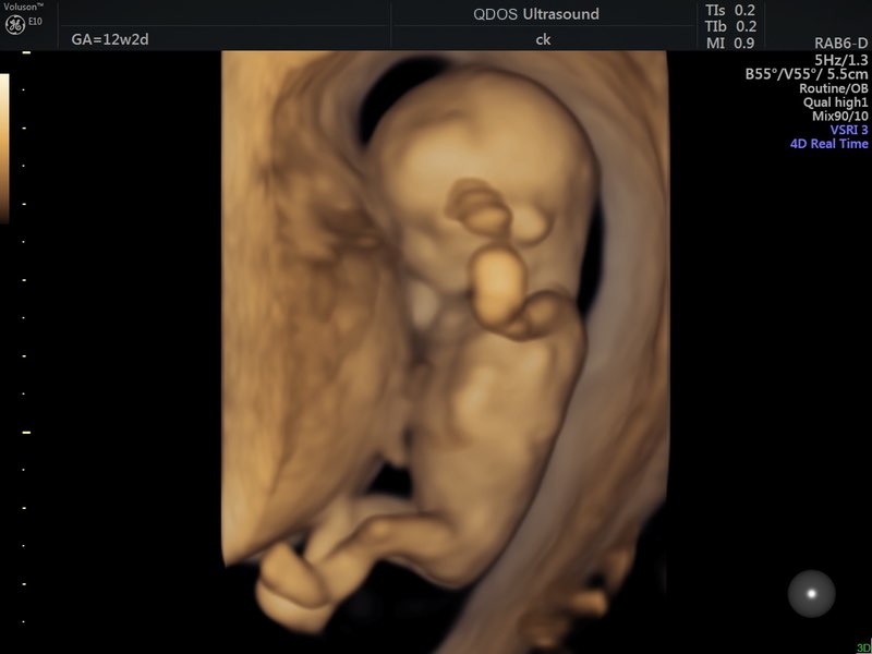 3d 4d ultrasound pictures 12 weeks comparison