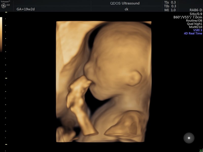 19 Week Scan Perth Mid-trimester | Pregnancy Scan Perth